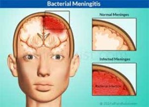 Meningitis